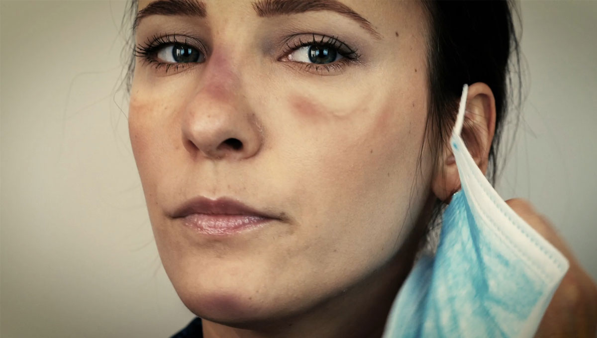 PPE Skin Issues Faced by Corovid-19 Front Line Workers
